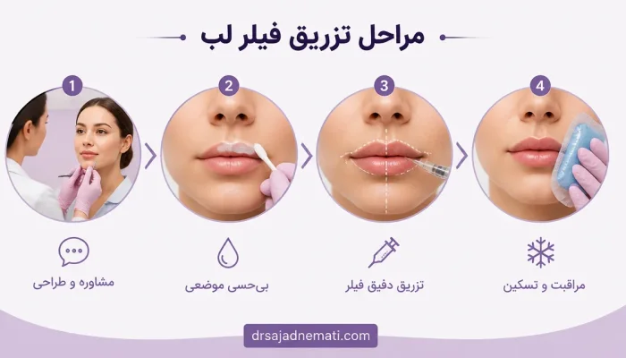 مراحل تزریق فیلر لب چگونه انجام میشود — مراحل ایمن و دقیق تزریق فیلر لب